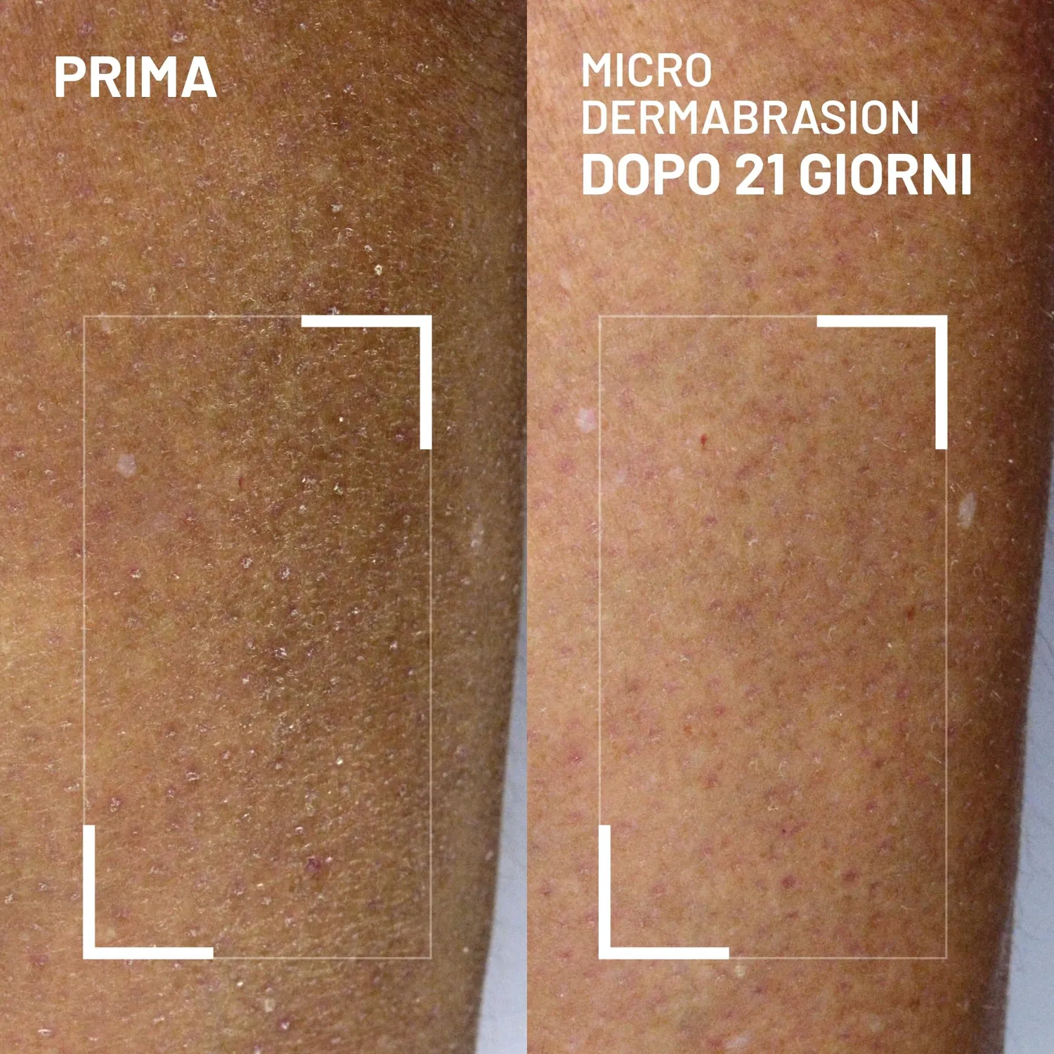 Dr. Brandt Microdermabrasion esfoliante corpo 125 g idratante