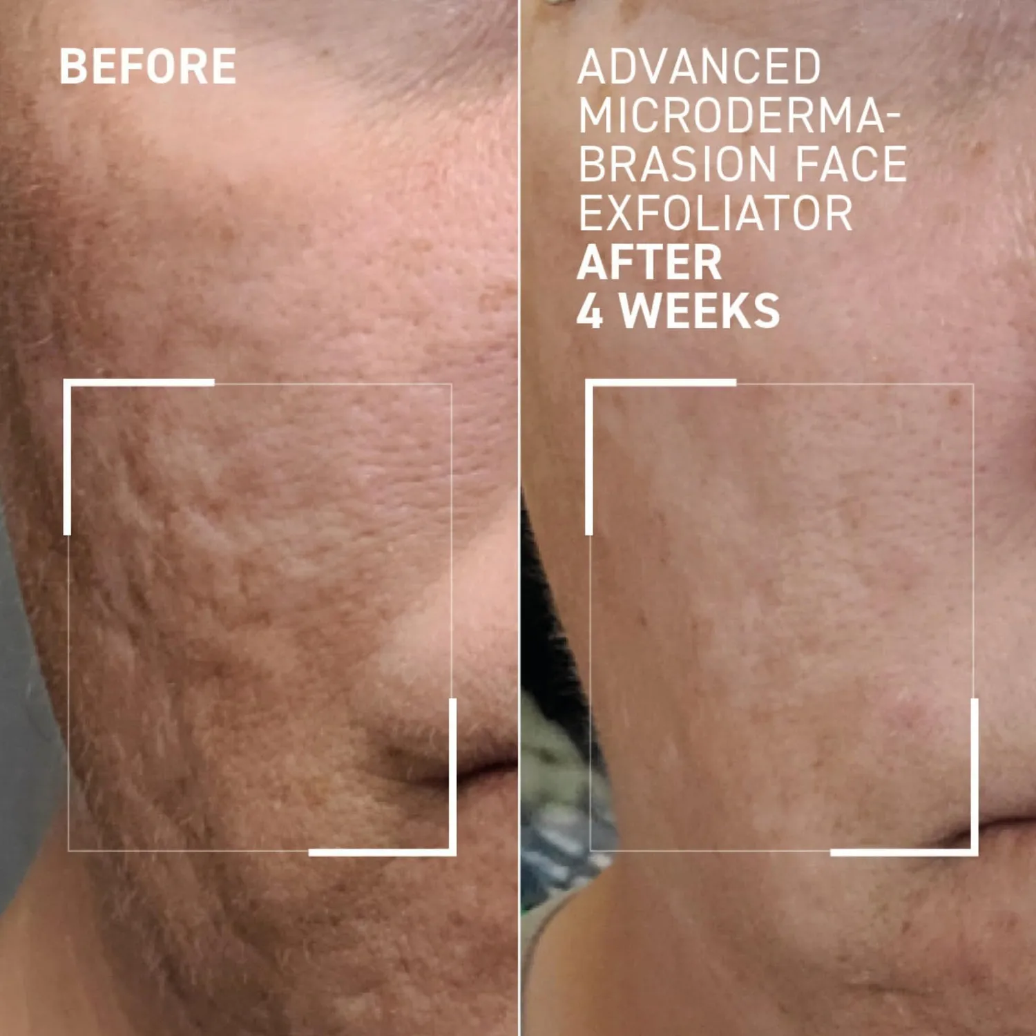 Brandt Advanced Microdermabrasion esfoliante viso 2 oz rughe visibili